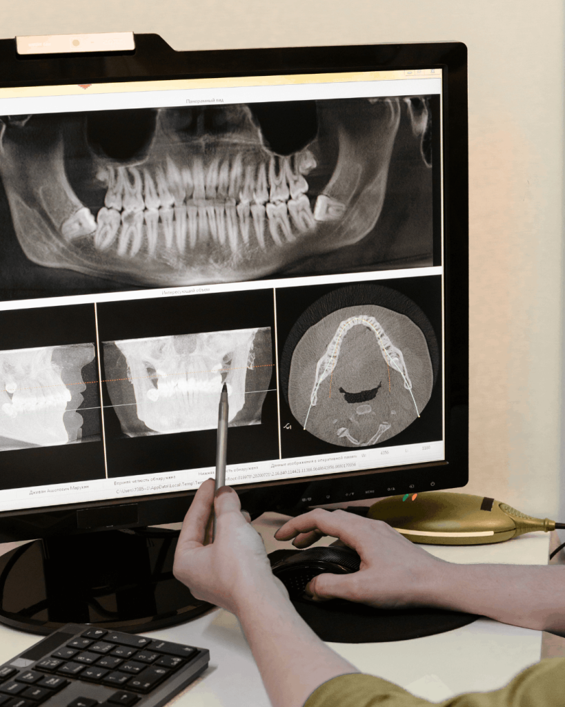 Endodonție la Microscop www.smilebydrilia.ro 2612