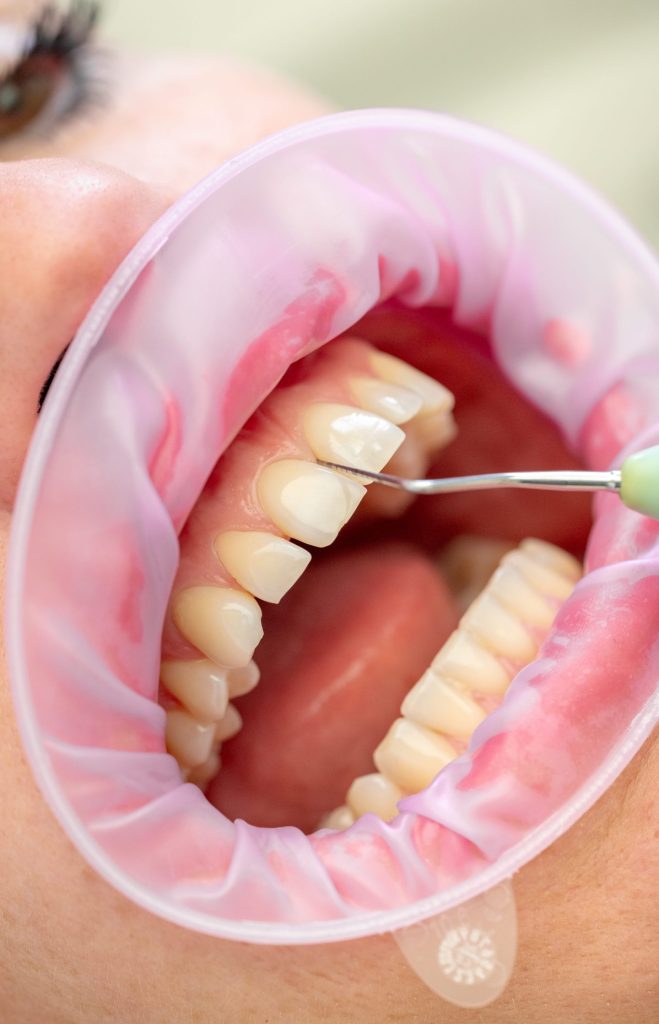 Profilaxie & Sănătatea Gingiilor www.smilebydrilia.ro 2623