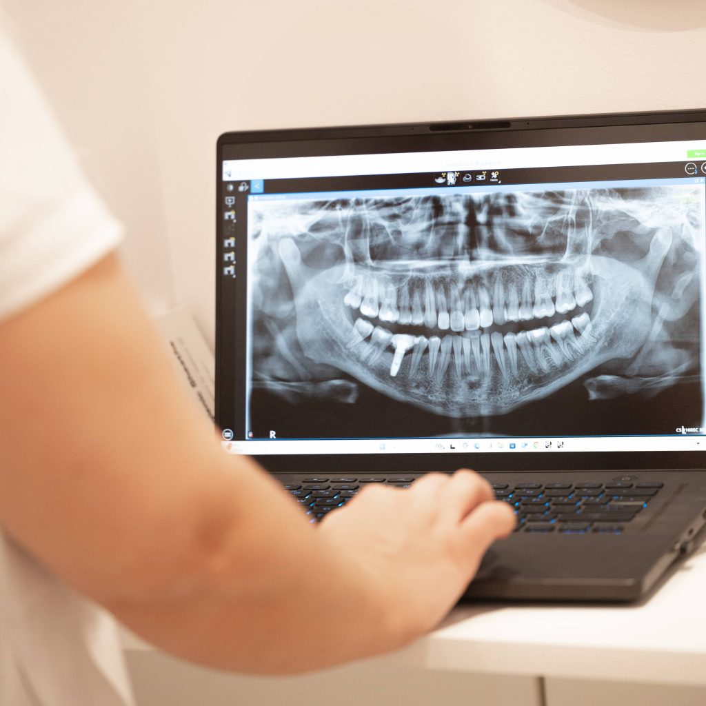 Implantologie & Dinți Ficși www.smilebydrilia.ro 2603