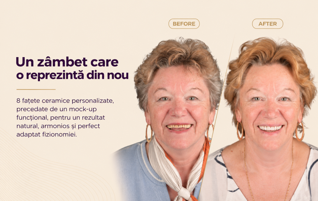 Caz 2: Povestea Irinei www.smilebydrilia.ro 3144