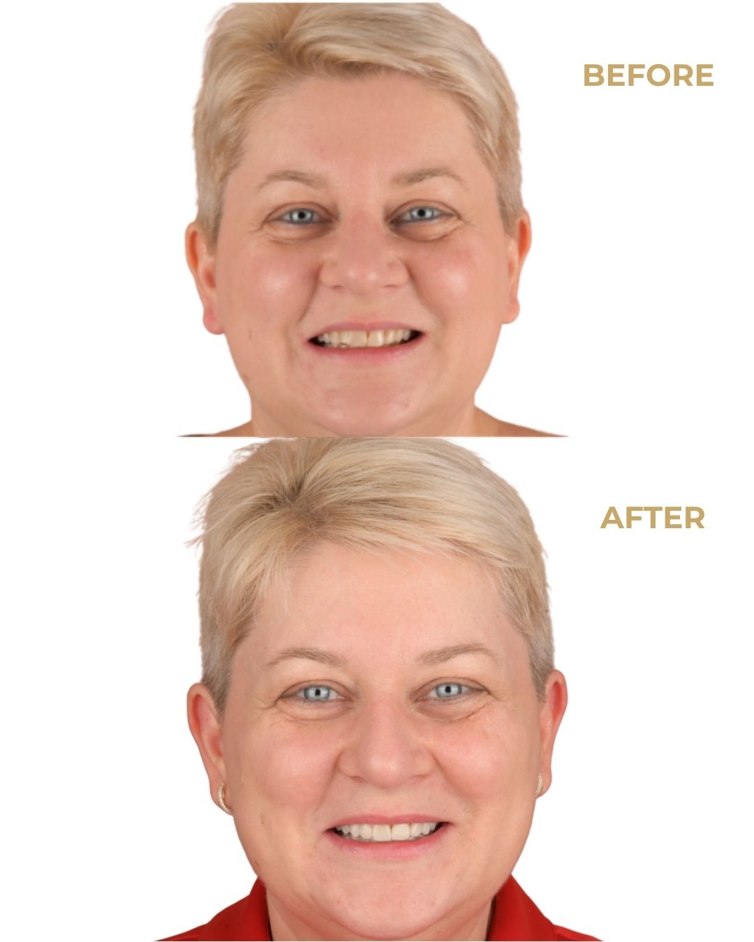 Caz 4: Povestea Aureliei www.smilebydrilia.ro 3163
