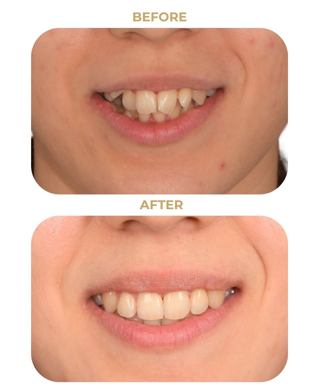 Caz 5: Povestea Dianei www.smilebydrilia.ro 3577