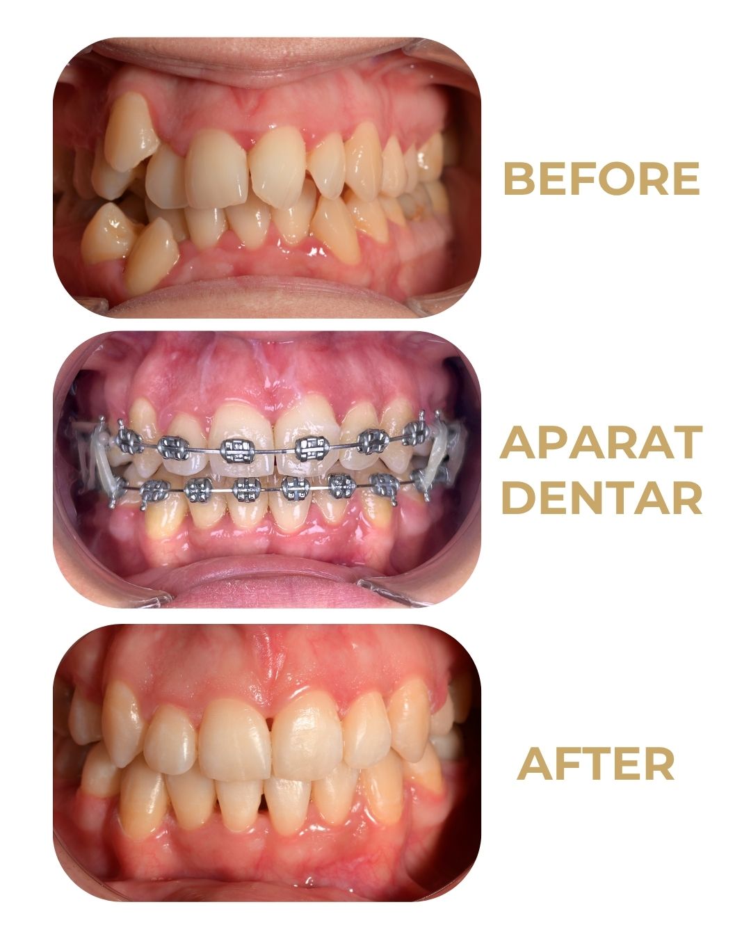 Caz 5: Povestea Dianei www.smilebydrilia.ro 3578