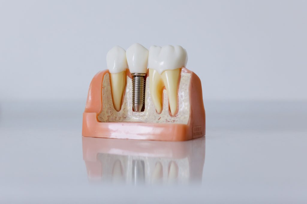 Implant dentar sau punte dentară? Cum alegi cea mai bună soluție? www.smilebydrilia.ro 2945