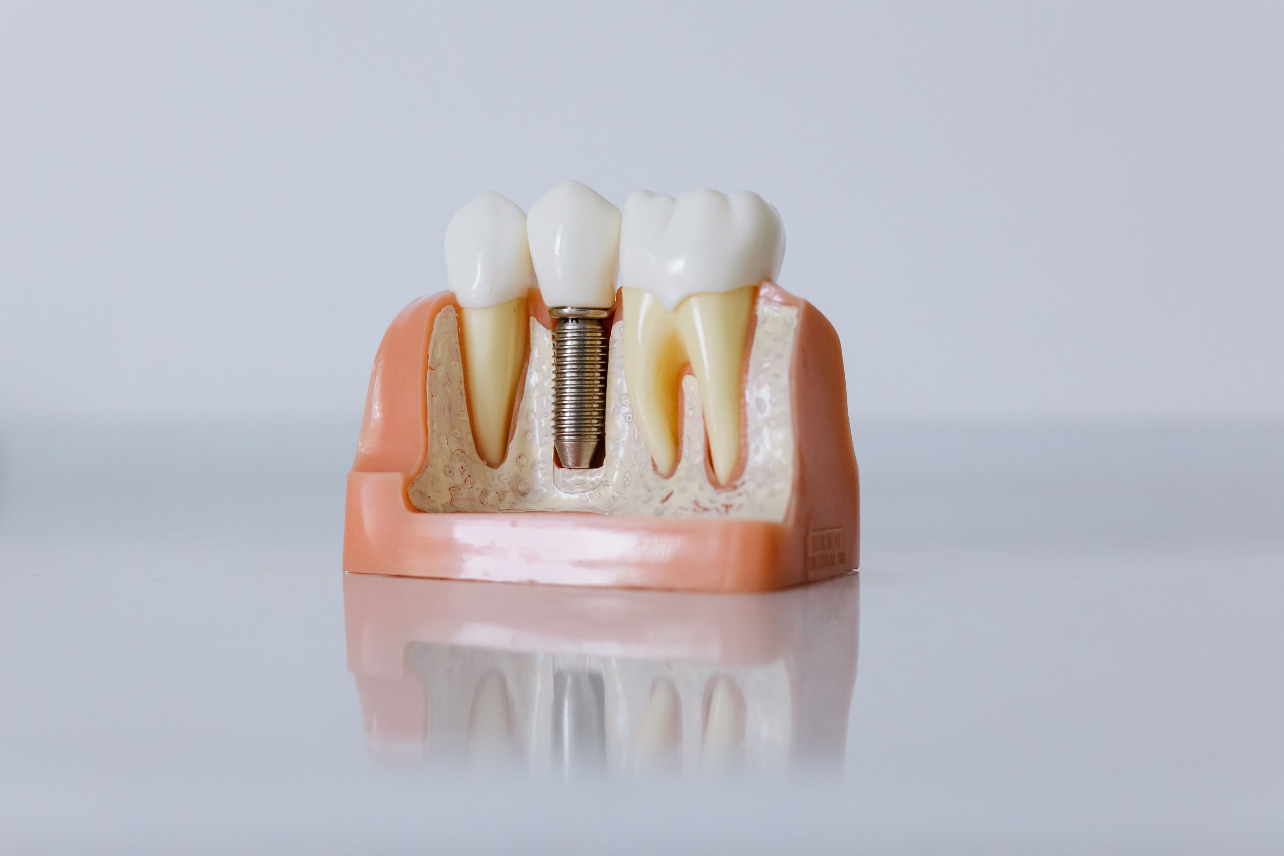 Implant dentar sau punte dentară? Cum alegi cea mai bună soluție? www.smilebydrilia.ro 2945