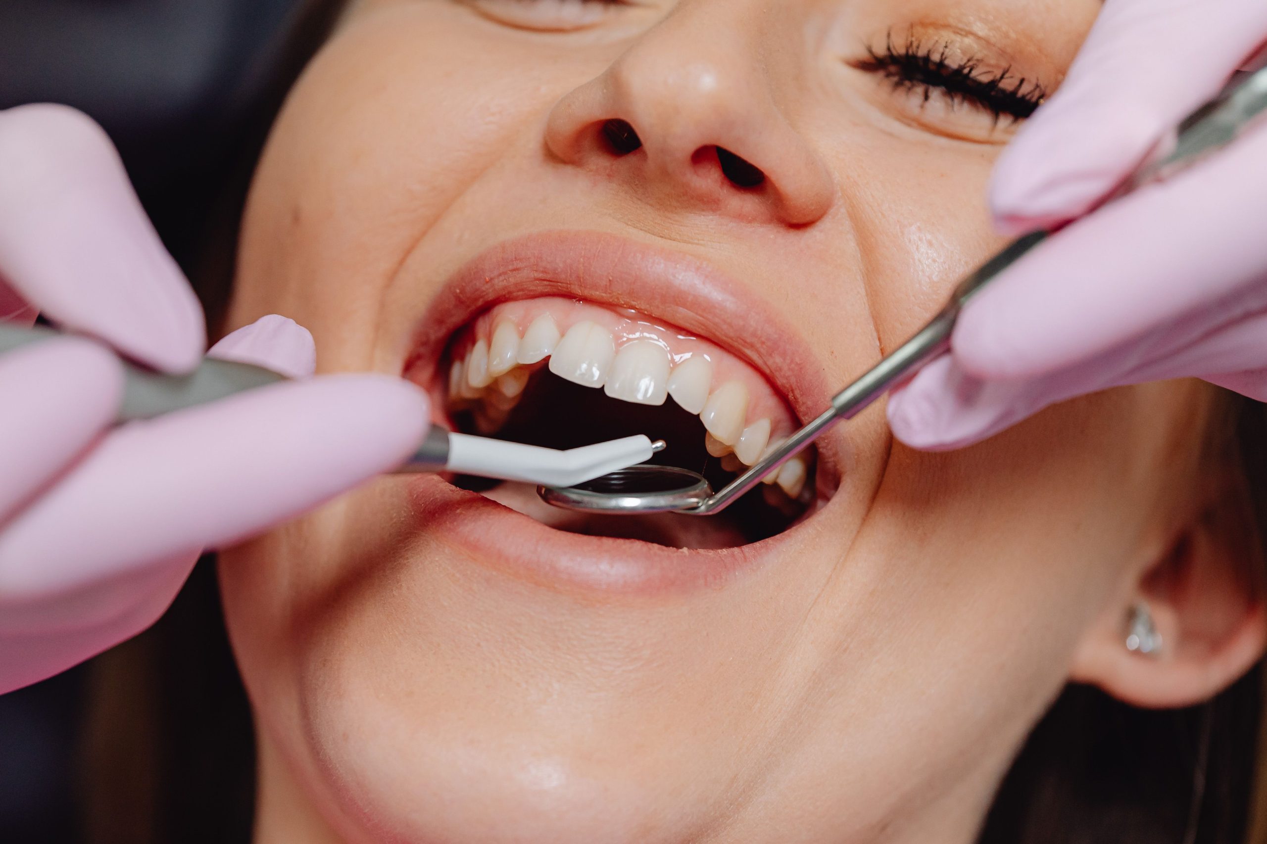 Cât costă un detartraj și de ce diferă atât de mult prețurile? www.smilebydrilia.ro 2992