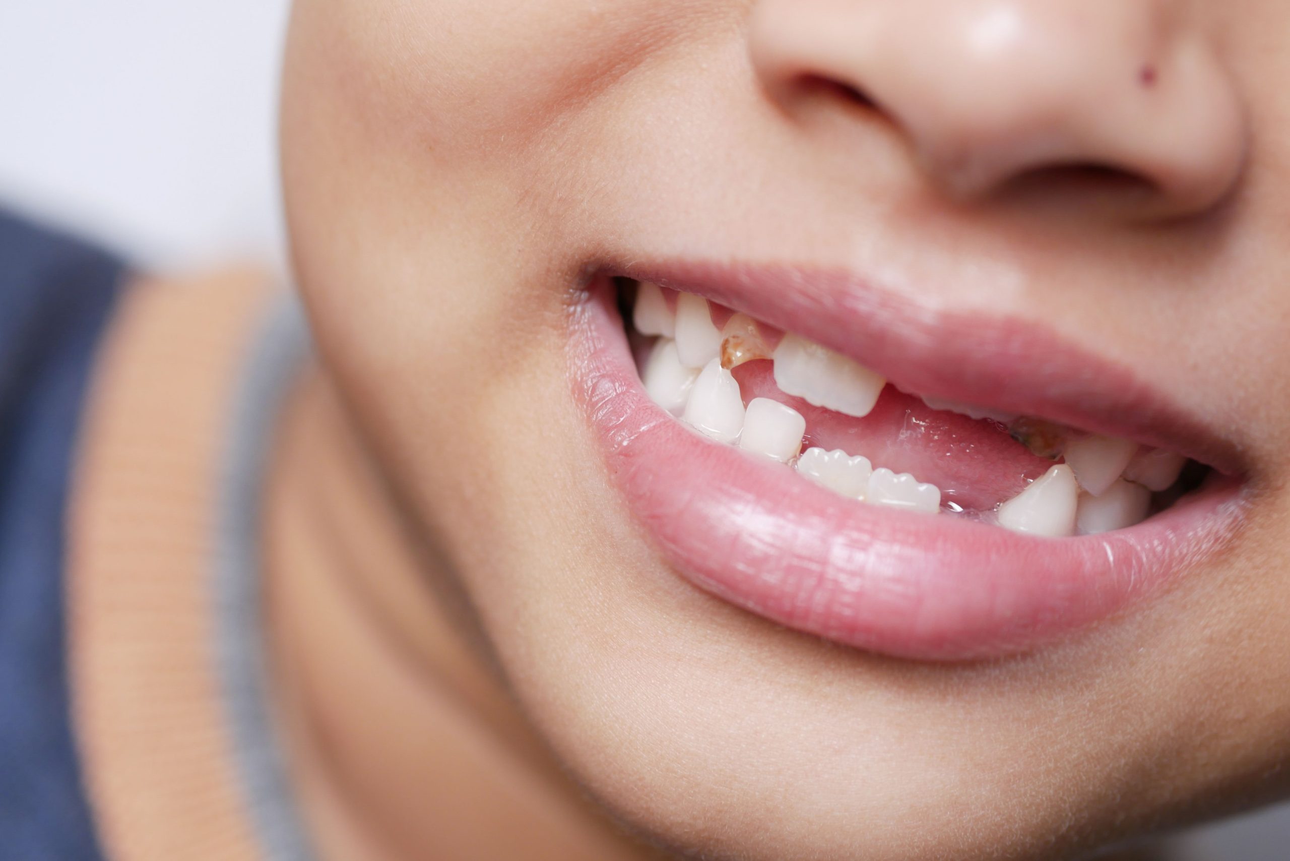Dinții de lapte trebuie tratați? De ce sunt atât de importanți? www.smilebydrilia.ro 2972
